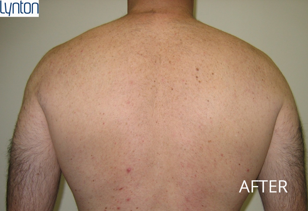 back-a